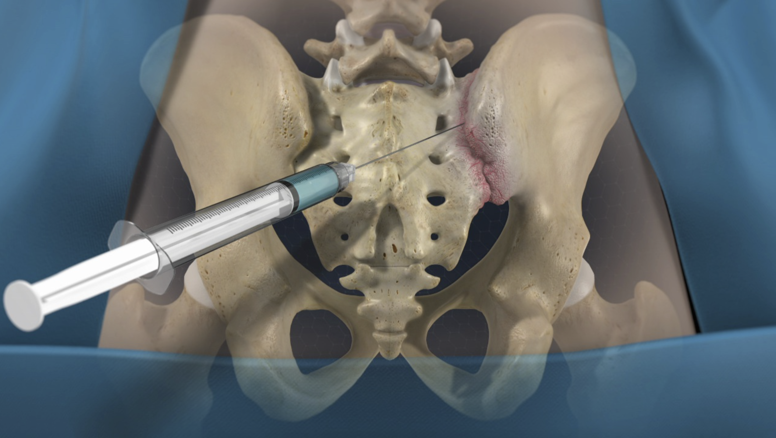 Sacroiliac Joint Injections