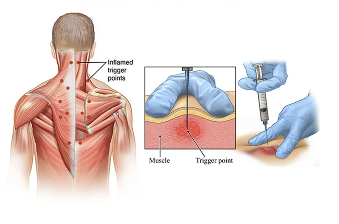 Trigger-Point-Injection