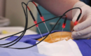 Radiofrequency-Ablation_-A-Minimally-Invasive-Solution-for-Chronic-Pain