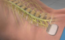 Spinal Cord Stimulator vs. Traditional Pain Treatments_ Which Is Best