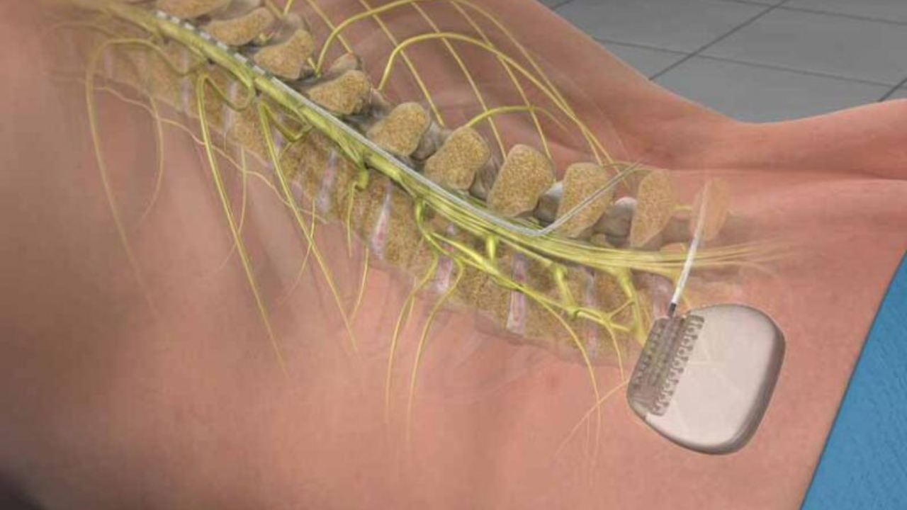 Spinal Cord Stimulator vs. Traditional Pain Treatments_ Which Is Best