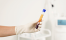 The Benefits of Platelet-Rich Plasma (PRP) Therapy for Pain Relief