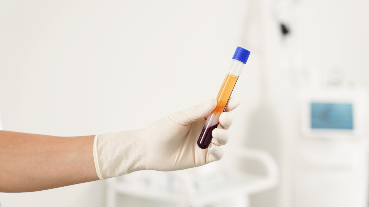 The Benefits of Platelet-Rich Plasma (PRP) Therapy for Pain Relief