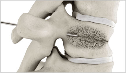 balloon-kyphoplasty-step-1