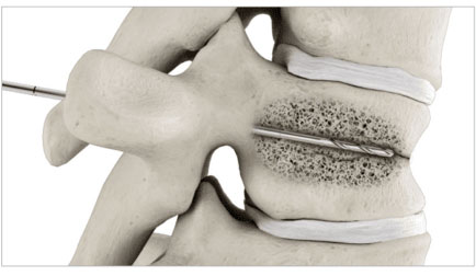 balloon-kyphoplasty-step-2