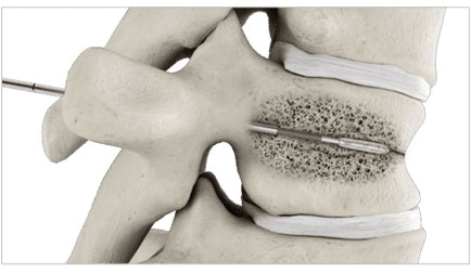 balloon-kyphoplasty-step-3