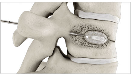 balloon-kyphoplasty-step-4