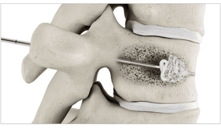balloon-kyphoplasty-step-5