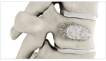 balloon-kyphoplasty-step-6