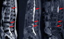 Spinal Stenosis