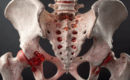 Sacroiliac Joint Dysfunction