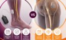 Temporary vs Permanent Peripheral Nerve Stimulation Devices Explained