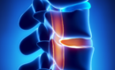 Spinal Cord Stimulator Recovery_ A Week-by-Week Timeline
